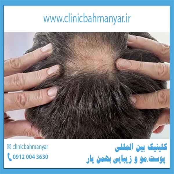 جلوگیری از ریزش مو _ راهکار های موثر در درمان ریزش مو